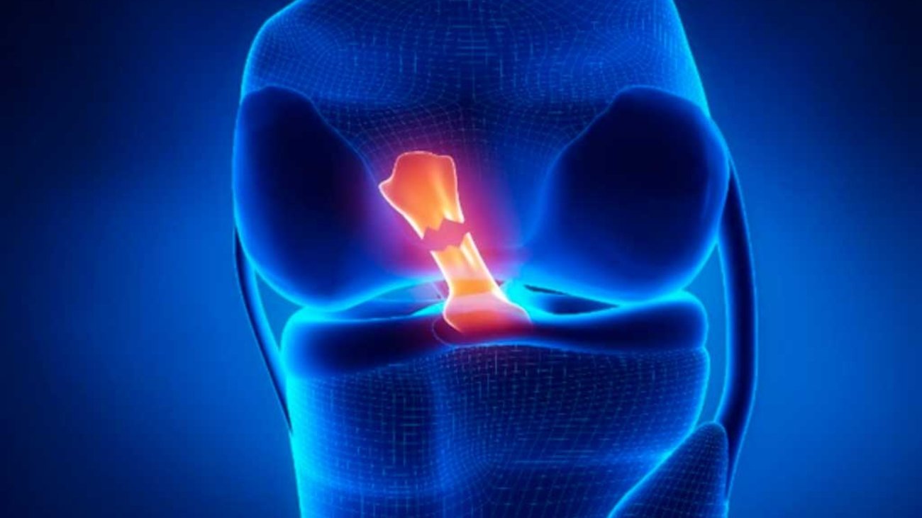 cirurgia-de-ligamento-cruzado-anterior-lca-instituto-trata